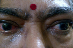 exophthalmos-compressed