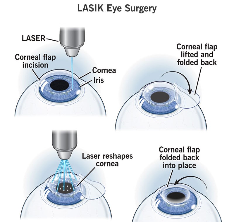 Refractive Surgery By The Best Ophthalmologist In Kolkata​