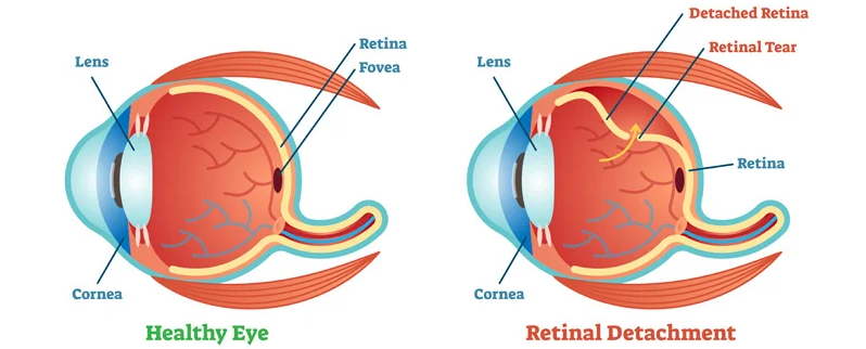 Retina Surgery by the best eye surgeon / doctor in Kolkata
