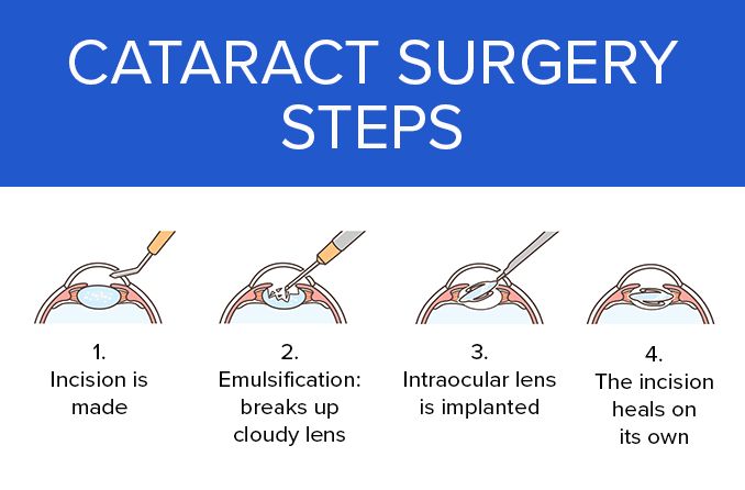 Cataract Surgery By The Best Eye Surgeon In Kolkata​